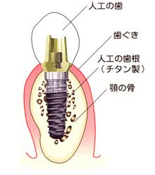 インプラント